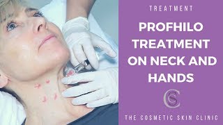 Profhilo Treatment On Neck and Hands  The Cosmetic Skin Clinic [upl. by Hardej]