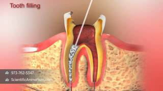 Root Canal Treatment [upl. by Eadnus168]