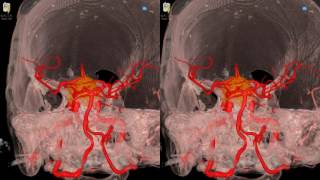 Cavernous Meningioma  3D Virtual Tour  UCLA Neurosurgery [upl. by Timothee]