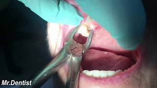 Extraction Of Molar Tooth [upl. by Artenak]