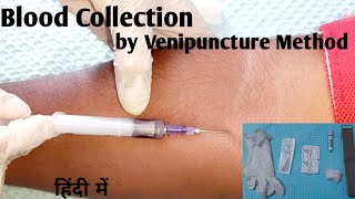 Treatment for Varicose Veins Procedures Hindi  CIMS Hospital [upl. by Dayna51]