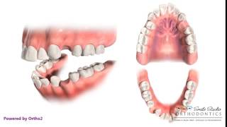 4 First Premolar Extraction for Retraction  Orthodontic Treatment [upl. by Yremrej389]