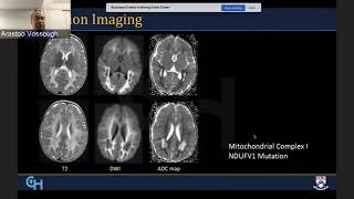 Radiological Diagnosis and Approach to Leukodystrophies [upl. by Anisirhc]