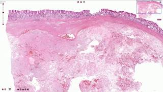 Gastrointestinal Stromal Tumor GIST  Histopathology [upl. by Laure]