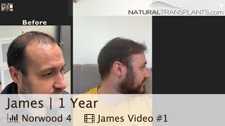 Norwood 4 Hair Transplant 1 Year PostSurgery Results  Dr Blumenthal James [upl. by Yolanthe713]