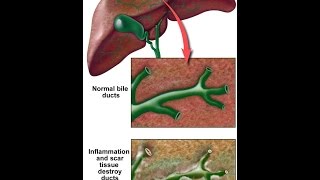 Primary Sclerosing Cholangitis [upl. by Wescott161]