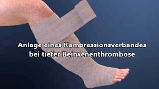 Kompressionsverband bei Thrombose [upl. by Lymann]