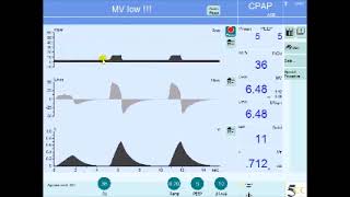 Pressure Support Ventilation PSV Description amp Settings [upl. by Nylahsoj]