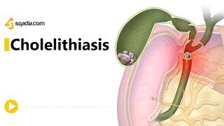 CHOLELITHIASIS GALL STONESPart 2 Pathogenesis Morphology Clinical FeaturesComplications [upl. by Batish]