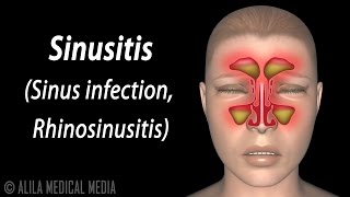 Sinusitis Animation [upl. by Etnaik]