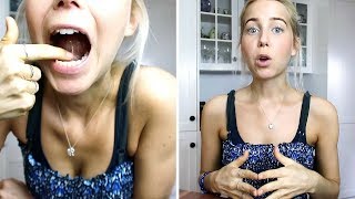 My Tongue Tie Surgery Experience [upl. by Anaej]